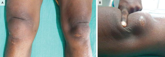 Quadriceps Tendon Ruptures