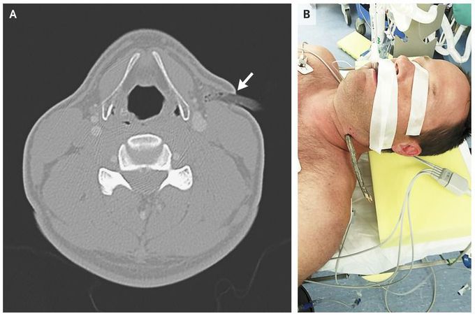 Neck Impalement during Mountain Biking