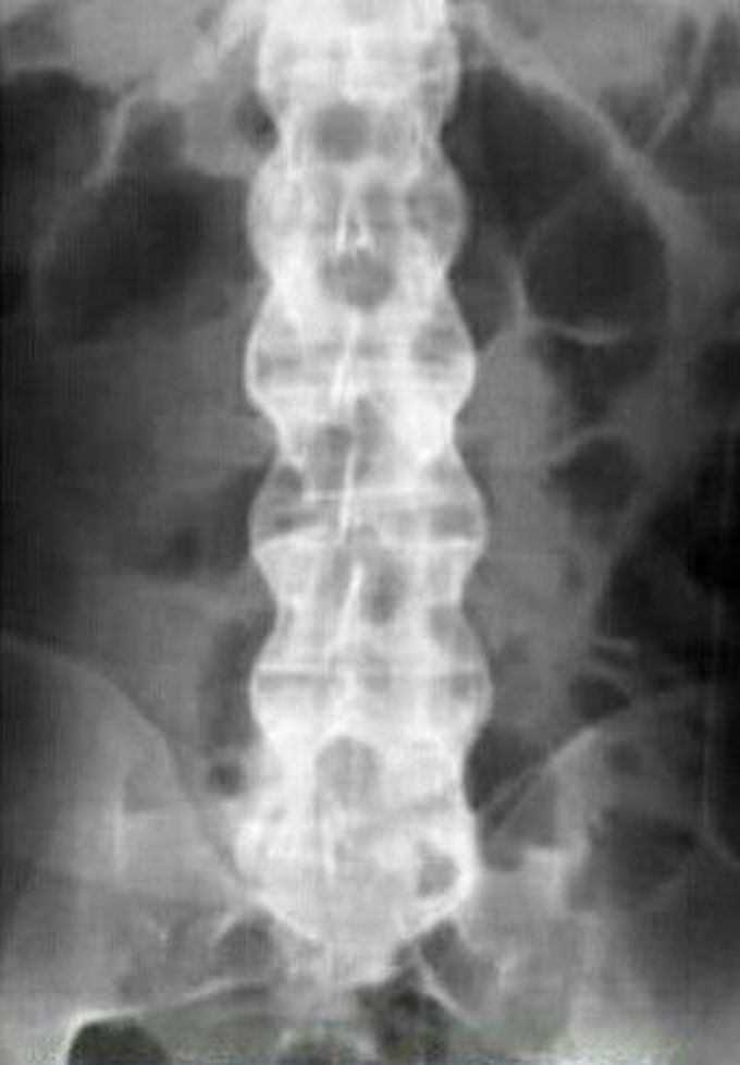 X_ray