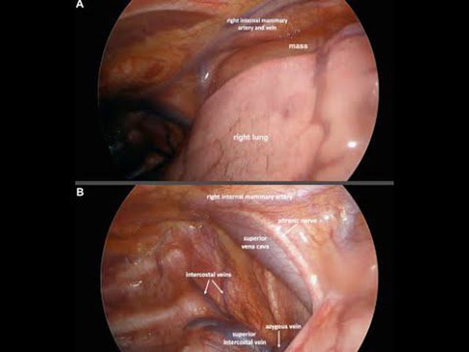 Video-Assisted Thoracoscopic Resection of a Large Anterior Mediastinal Mass