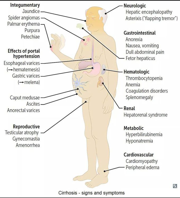 CIRRHOSIS