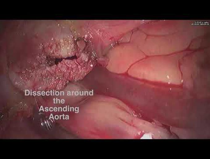 Minimally Invasive Direct Coronary Artery Bypass and Endoscopic Resection of Cardiac Tumor
