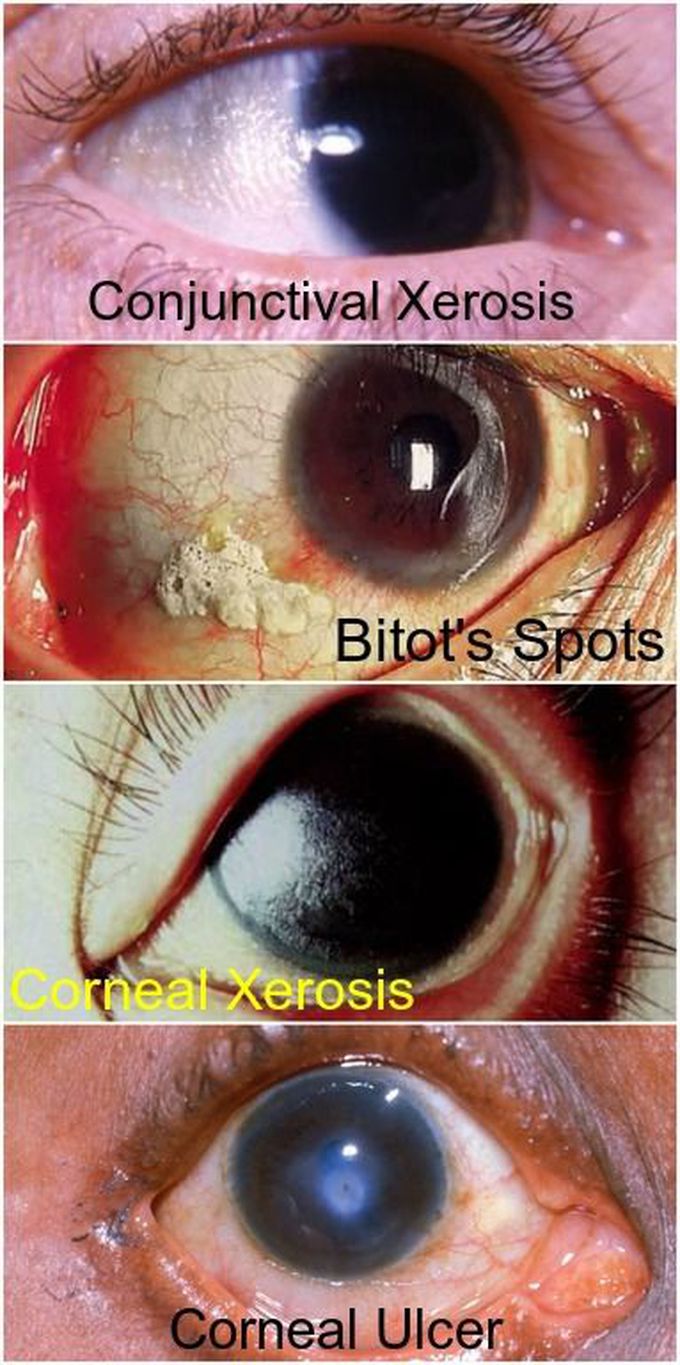 Eye Disease