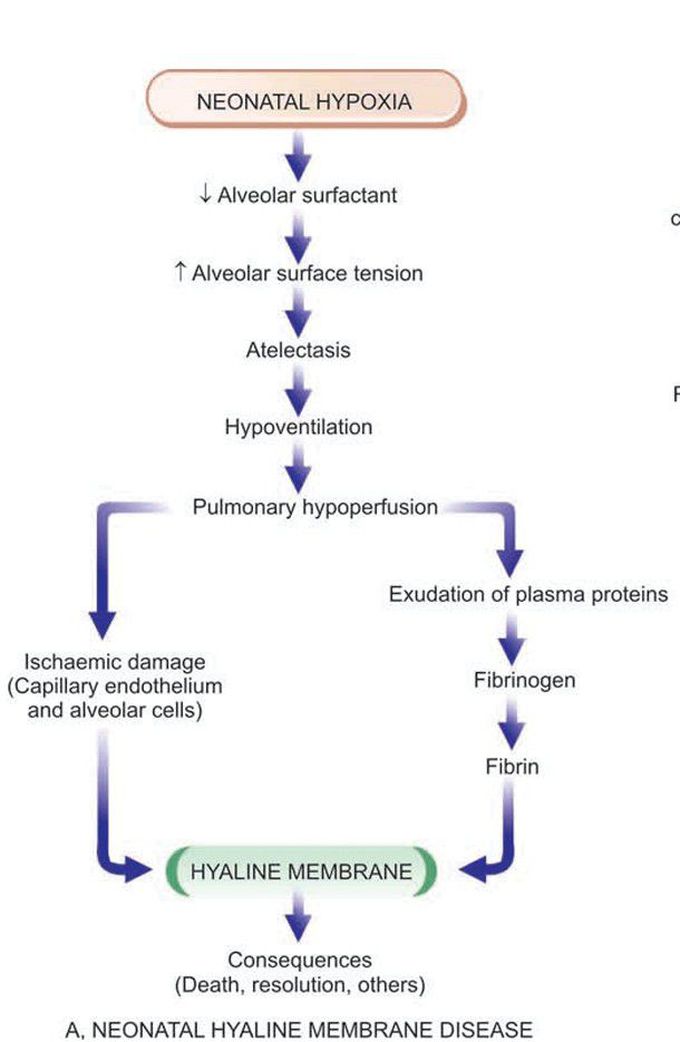 Neonatal hyaline membrane disease.