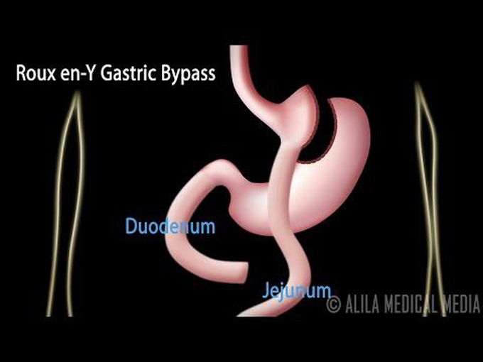 Gastric Bypass
- Animation
