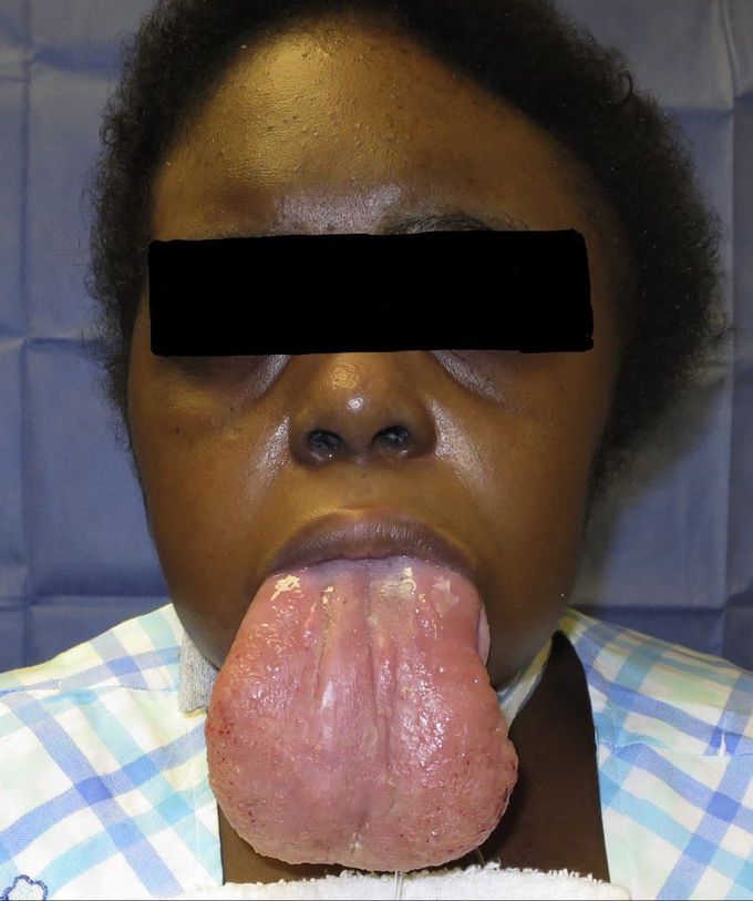 Macroglossia