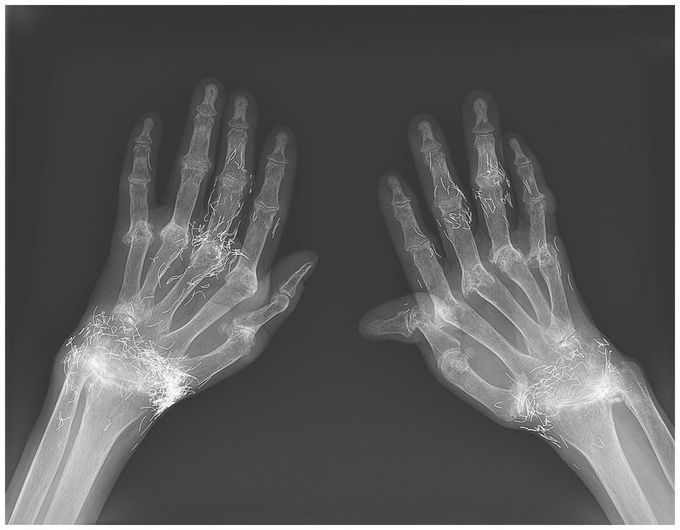 Gold Thread Acupuncture for Rheumatoid Arthritis