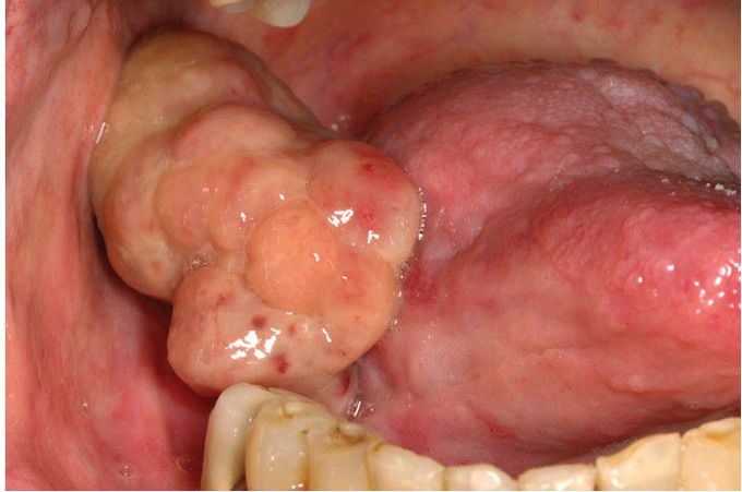 Spindle Cell Carcinoma