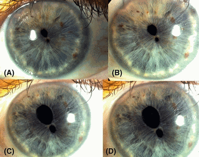 Polycoria: An unusual Eye Condition