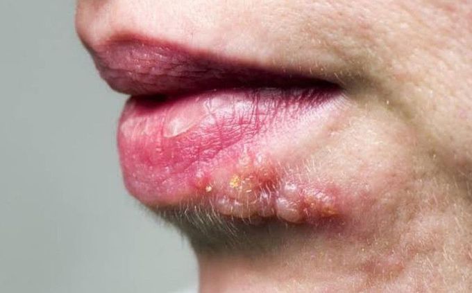 Herpes Labialis