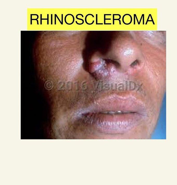 Rhinoscleroma