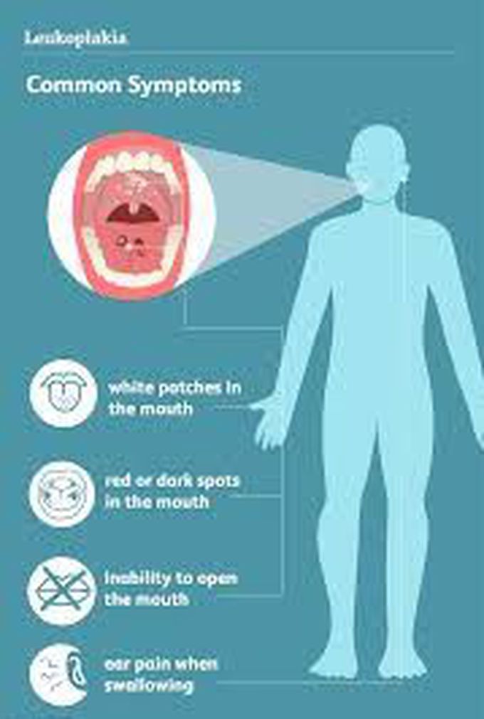 Symptoms of leukoplakia