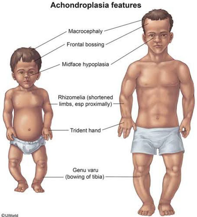 Achondroplasia