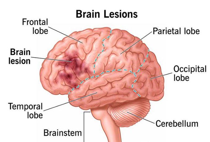 Brain lesions