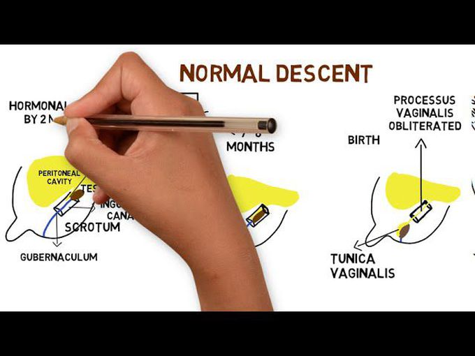 Normal Testicular Descent and Cryptorchidism