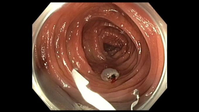 Colon Polyp with Cancer