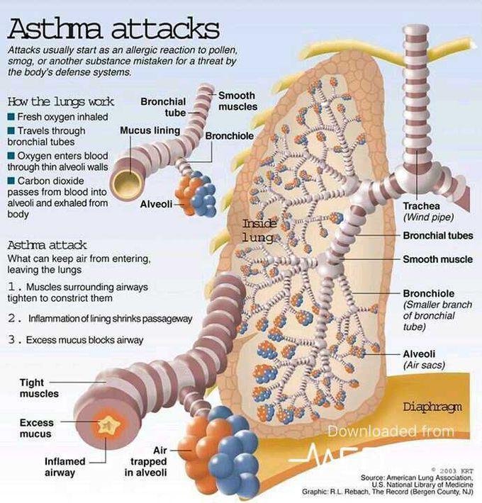 Asthma attack