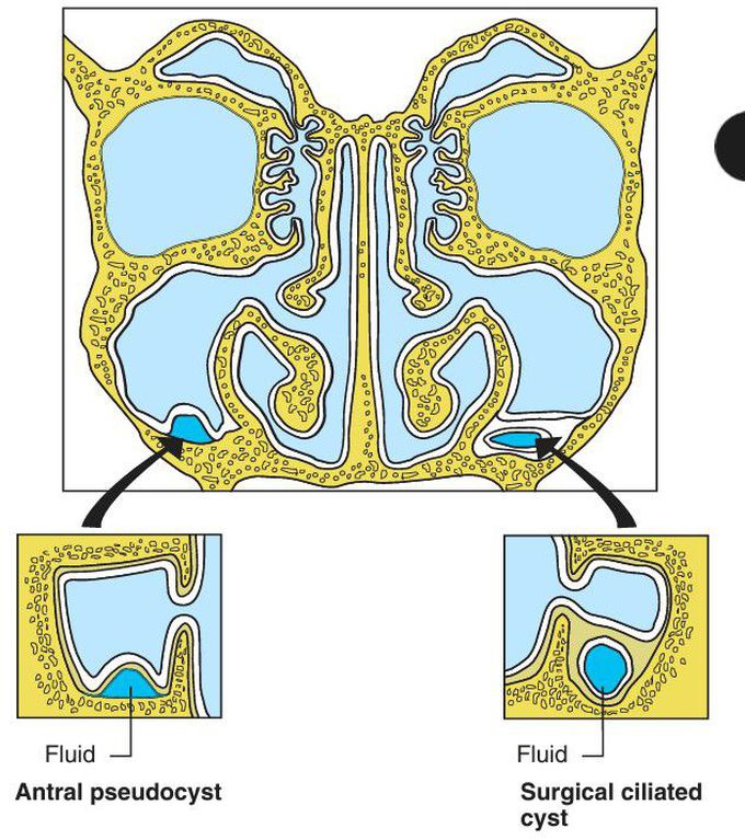 Antral Pseudocyst and Surgical Ciliated Cyst