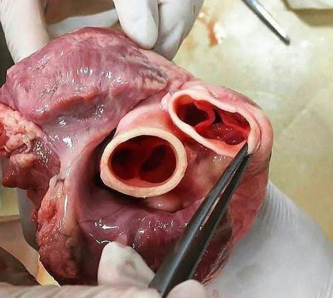 Heart Valve