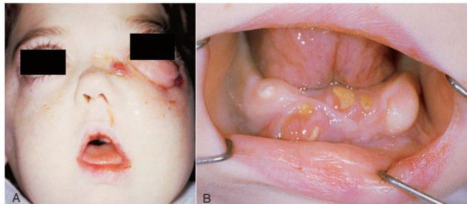 Osteopetrosis