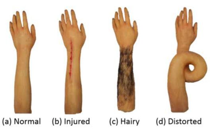 Complex Regional Pain Syndrome (CRPS) is also known as: