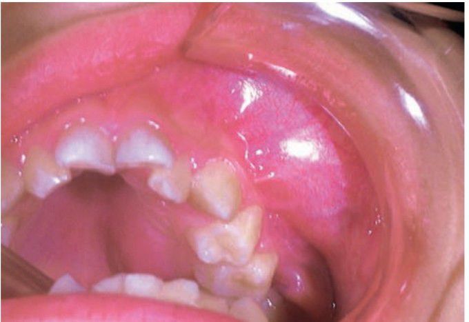 Burkitt's lymphoma