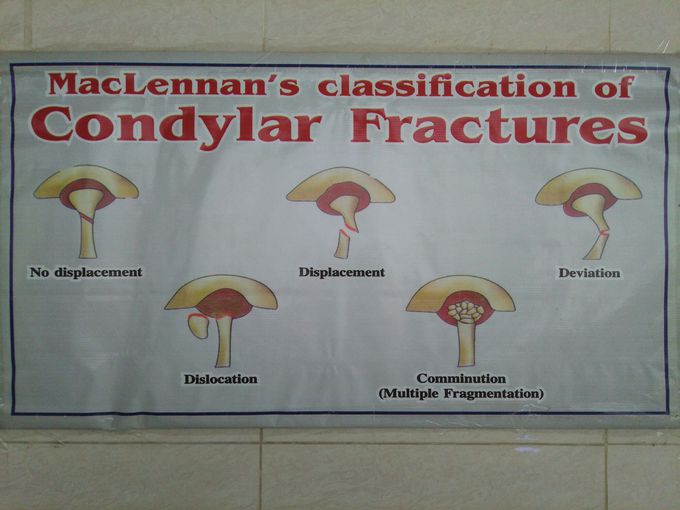 Condylar fracture