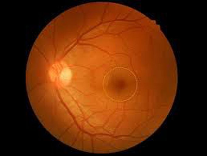 How to manage retinal hole?