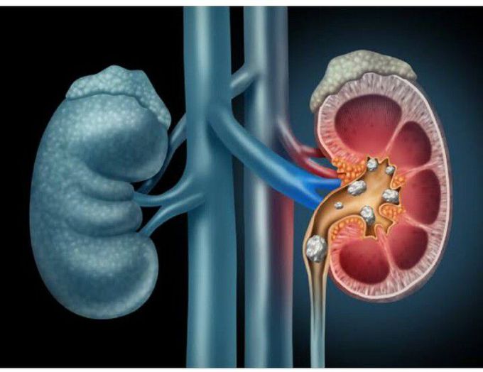 Nephrolithiasis