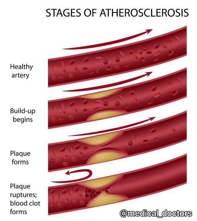 AtHerOsclerosis