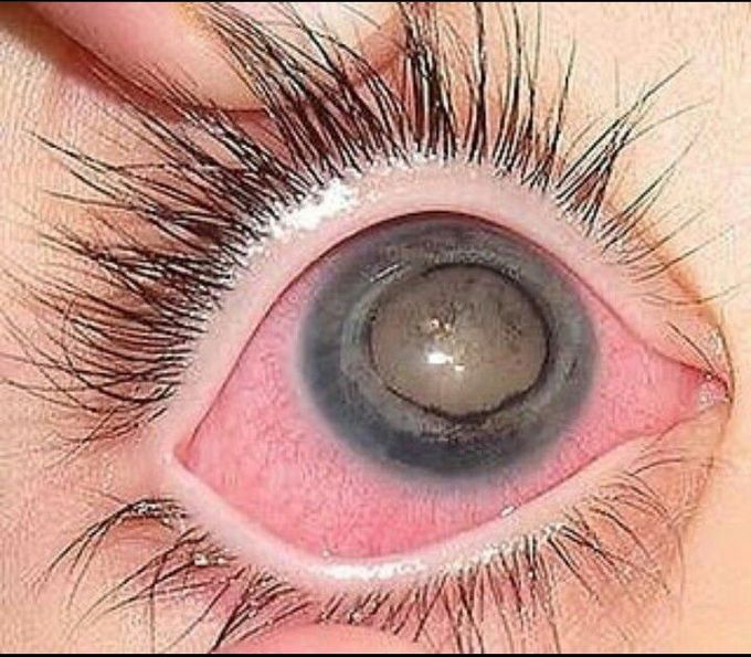 Coat's Disease