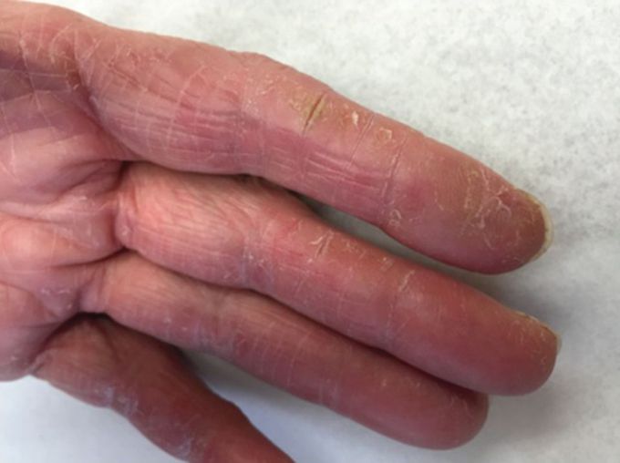 In which rheumatolohic disease we see mechanic hand? !