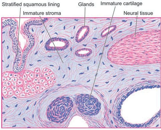 Immature teratoma testis.