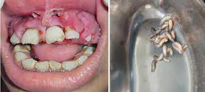 Treatment of oral myiasis