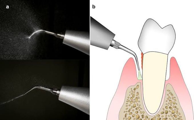 Ultrasonic scaling