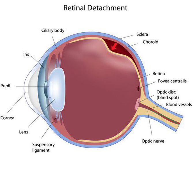 what happens when intra retinal space persists?