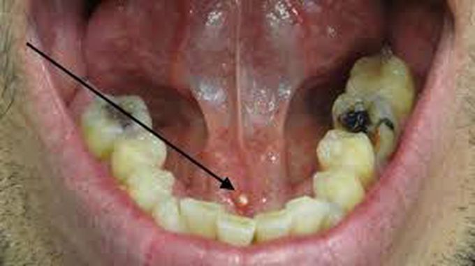 Treatment of sialolithiasis