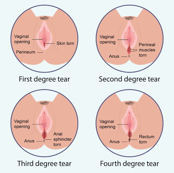 Perineal Tear Grading