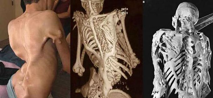 FIBRODYSPLASIA OSSIFICANS PROGRESSIVA (FOP)