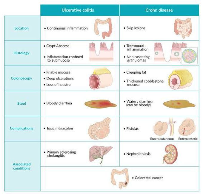 Ulcerative Colitis vs Crohn Disease