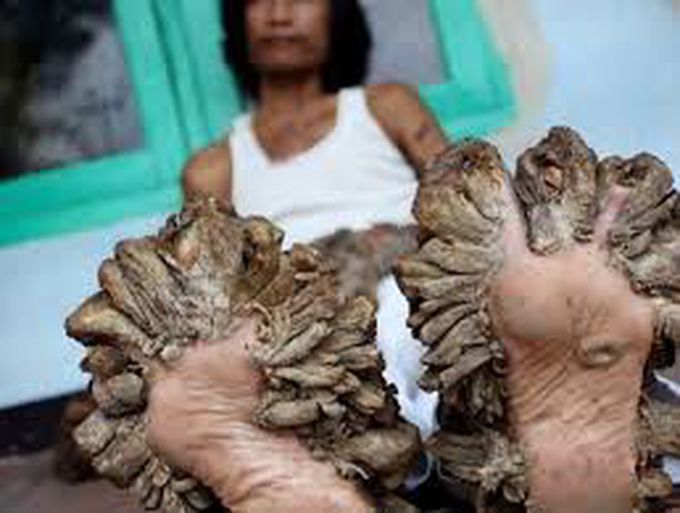 Epidermodysplasia verruciformis
