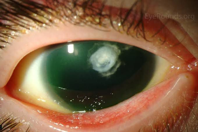 Embryo , opthalmology