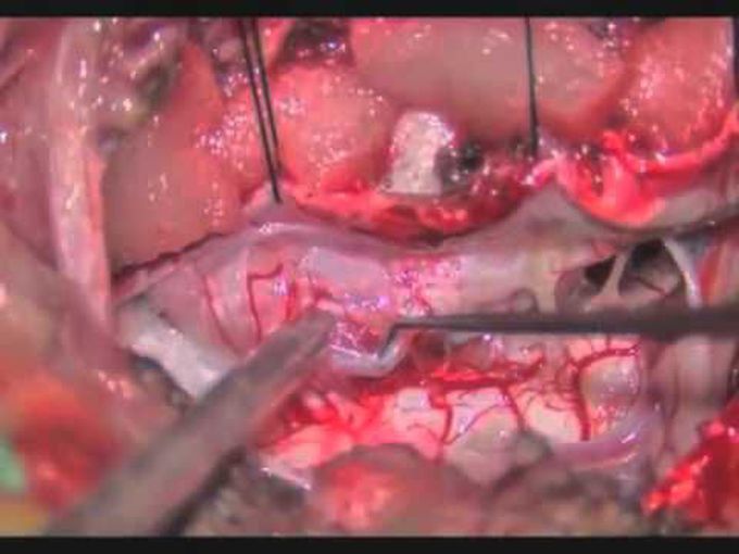 Extreme lateral transcondylar approach: meningioma of the CVJ & upper cervical spine