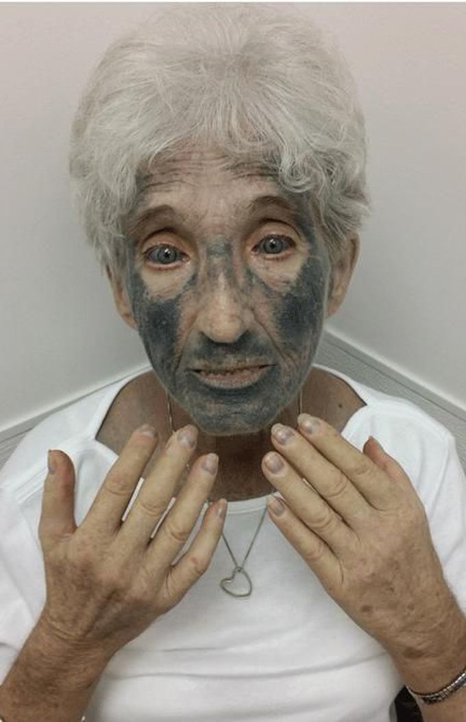Hyperpigmentation Caused by Minocycline