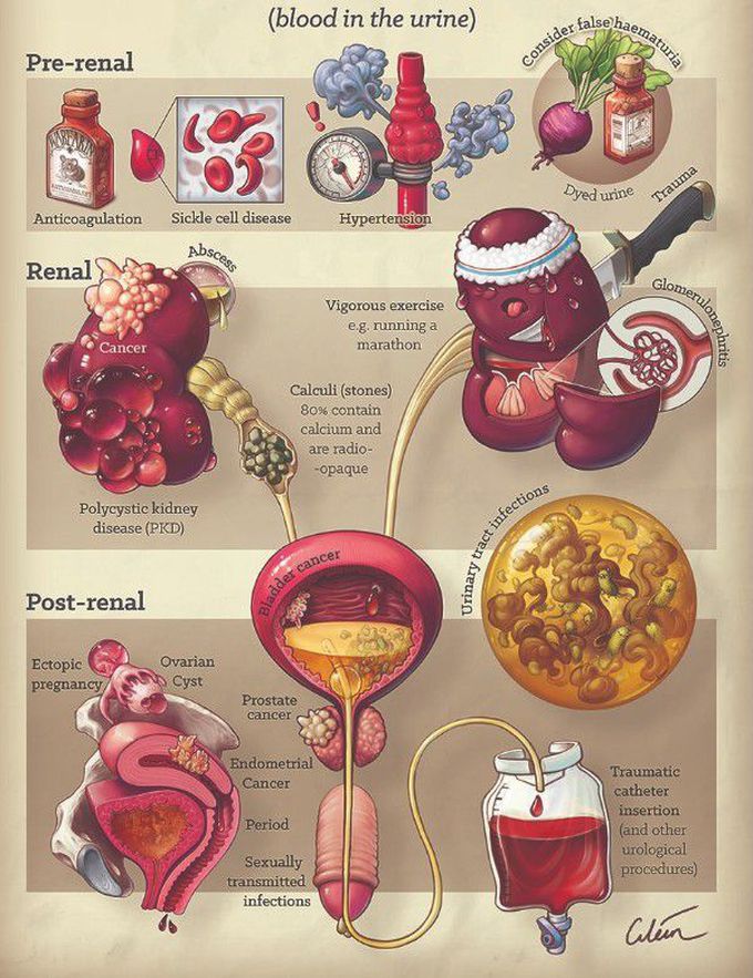 Cause of Hematuria