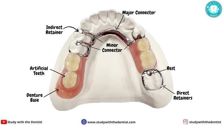 Components of partial denture - MEDizzy