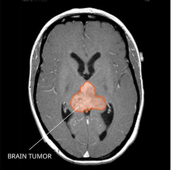 Treatment of rhabdoid tumor