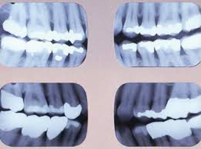 Bitewing radiograph