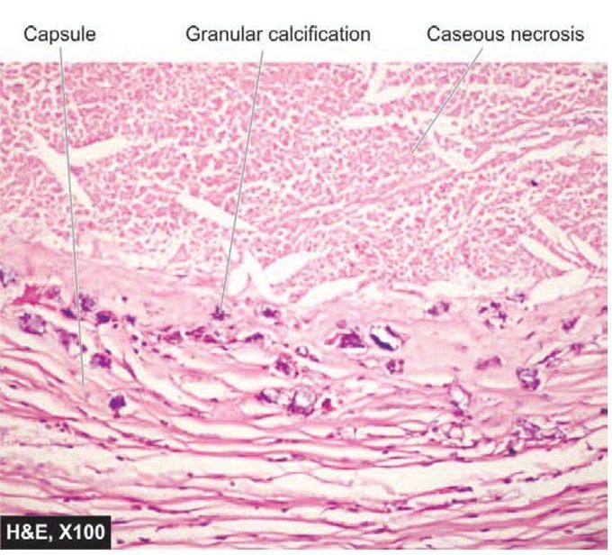 Dystrophic calcification