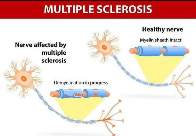 Multiple sclerosis